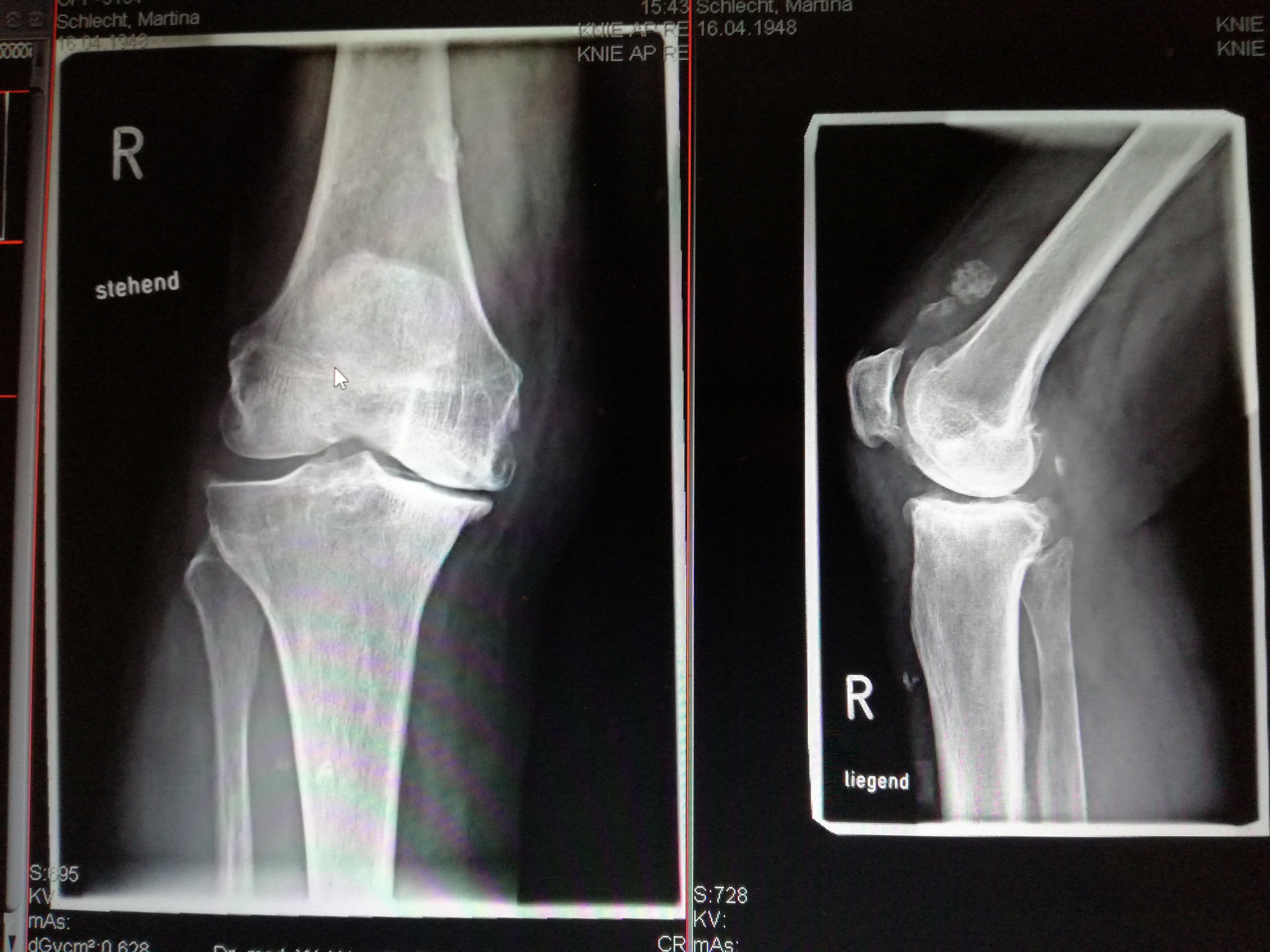 Knieendoprothetik | Orthopädie Peiting/Landsberg