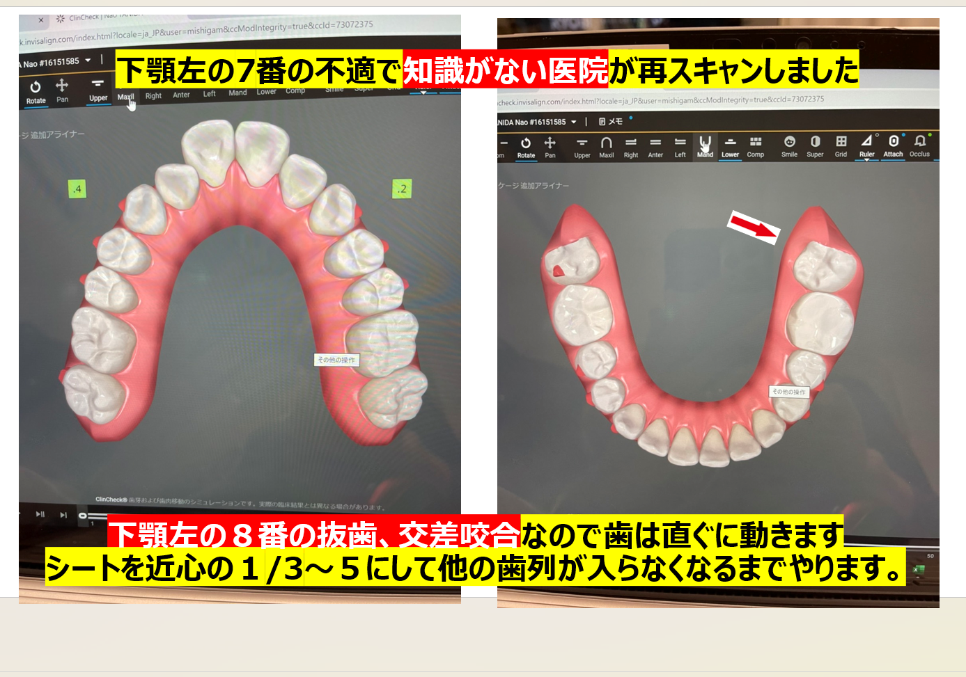 アライナー矯正治療 診断/治療計画/矯正治療/顎位整復治療
